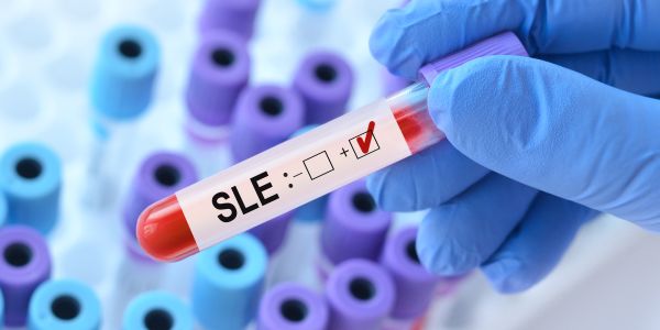 EBV and Lupus: Stanford’s “Breakthrough” or Long-Overdue Validation?