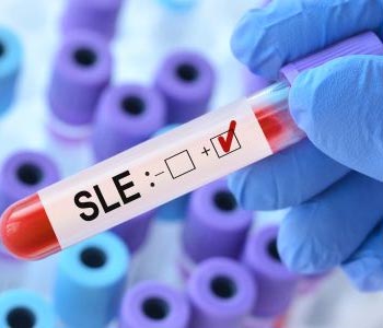 EBV and Lupus: Stanford’s “Breakthrough” or Long-Overdue Validation?